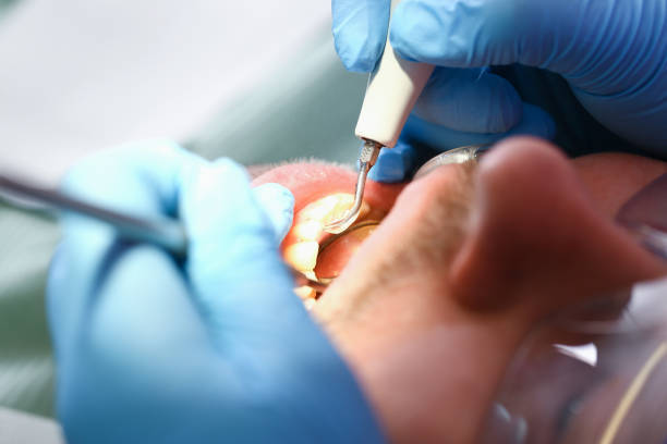 Best Emergency Dental Extractions in Stockton, KS
